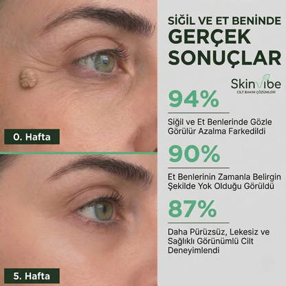 Skinvibe® - Vegan Siğil & Et Beni Bandı